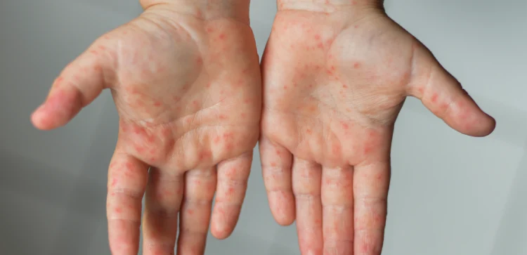 Alergólogo pediatra cerca de Cuajimalpa de Morelos en CDMX y Edo Mex