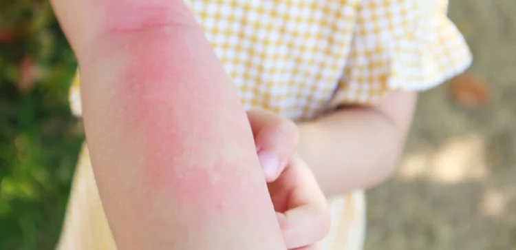 Asma y Alergias en Venustiano Carranza en CDMX y Edo Mex